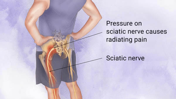 what-is-sciatica-gardens-wholistic-health-center